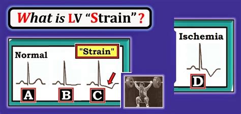 ECG Interpretation: ECG Blog #92 (Basic Concepts-5) – LVH