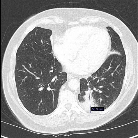 Cureus | Non-Small Cell Lung Cancer With Synchronous Peritoneal ...