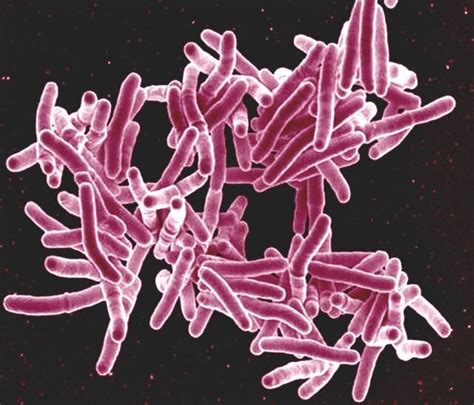 Rare genetic disease may protect Ashkenazi Jews against TB