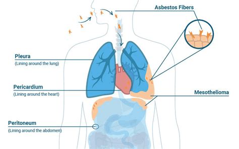 The Most Common Symptoms Of Mesothelioma - Updated Ideas