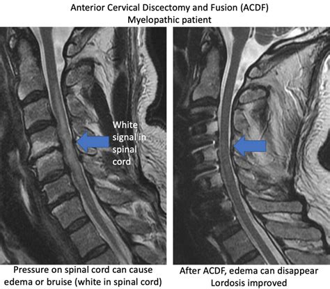 Anterior Cervical Discectomy and Fusion (ACDF) - Rocky Mountain Brain and Spine Institute