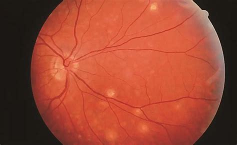 Multifocal choroiditis - American Academy of Ophthalmology