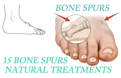 15 Bone Spurs (Neck And Knee) Natural Treatments That Work - natural