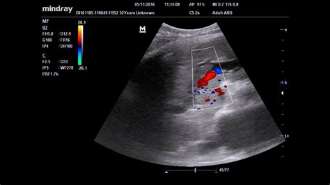 ultrasound portal vein thrombosis - YouTube