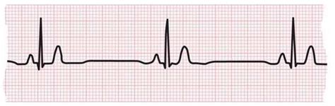 Bradycardia: Slow Heart Rate | American Heart Association