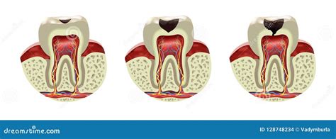 Human Tooth Decay Disease Cross Section Realistic View Stock ...