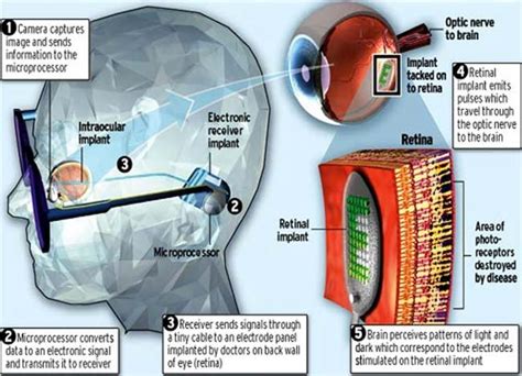 What is a Bionic Eye?