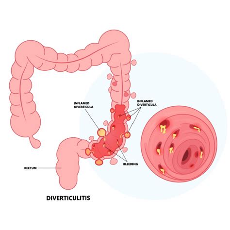 Diverticulitis | GI Infection | Charleston GI