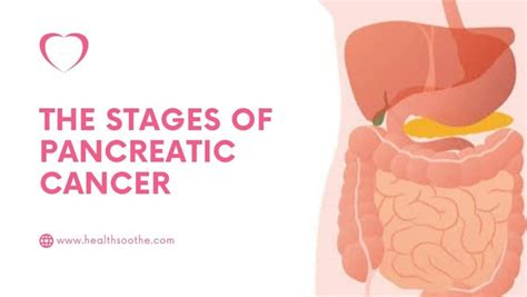 The Stages Of Pancreatic Cancer Healthsoothe: Health And Dental Care