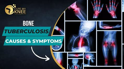 Bone Tuberculosis (TB): Causes, Symptoms, Types, Treatment