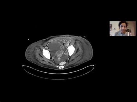 Combination treatment for necrotizing pancreatitis - Dr. Aarti Sekhar - YouTube