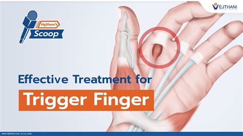 Effective Treatment for Trigger Finger | Vejthani's Scoop - YouTube