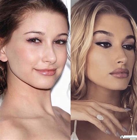 Hailey Bieber in 2020 | Celebrity plastic surgery, Celebrity skin, Lip plastic surgery