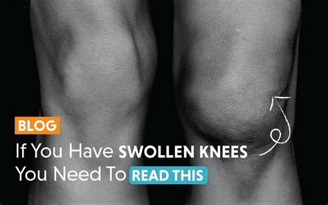 Must-Know Treatment for Knee Pain Relief | ViscoGen™ in Orlando