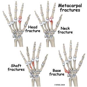 Metacarpal Fractures - Physiopedia