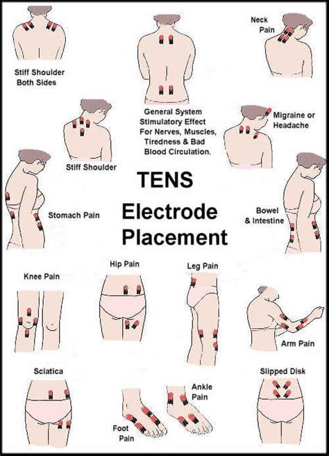 TENS Unit Electrode Placement Guide - prohealthcareproducts.com