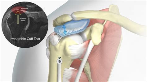 A Balloon for Rotator Cuff Tears? - Shoulder & Elbow