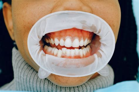Causes of Bleeding Gums - Best Dentist Staten Island
