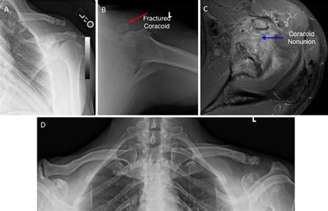 Coracoid bypass procedure: surgical technique for coracoclavicular reconstruction with coracoid ...