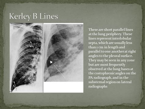 Loren Morgan. HTN CAD Bad Valves (Aortic Stenosis, Mitral Stenosis ...