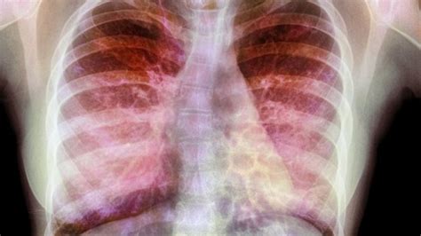 Gene therapy stabilises lungs of cystic fibrosis patients - BBC News