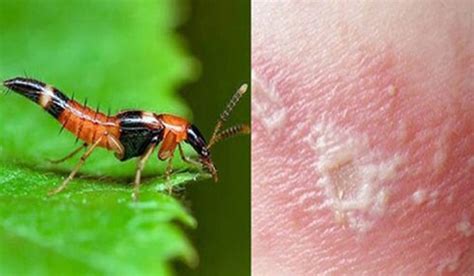 Trị như thế nào? Khi bị côn trùng cắn nổi mụn nước - pestcontrol