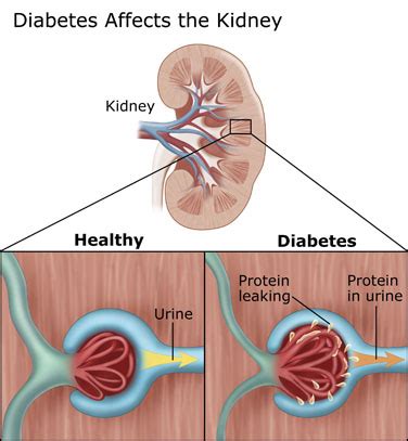 Kidney Complications - Diabetes Education Online