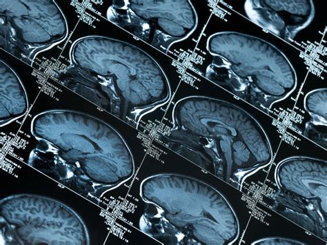 Brain Surgery: Purpose, Types, and Risks