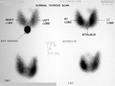 Thyroid Problems Explained | HubPages