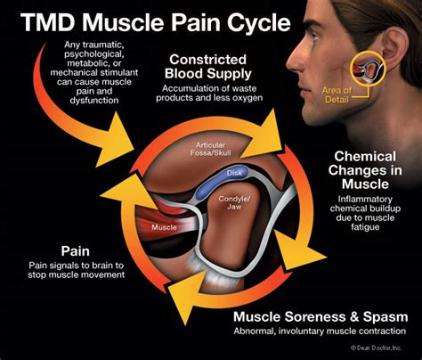 What You Need to Know About TMJ & TMD | Beacon Cove Dental