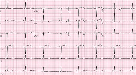 AAEM Resident and Student Association : Cardiology Pearl: Wellens' Syndrome