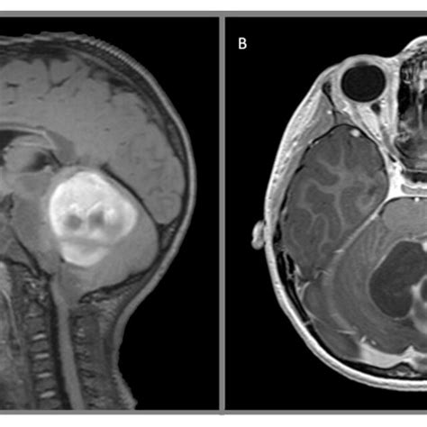 Juvenile pilocytic astrocytoma, WHO 1: (A) sagittal T2 FLAIR with ...