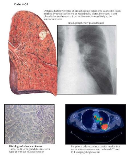 ADENOCARCINOMA OF THE LUNG | Lunges, Chronic obstructive pulmonary disease, Pulmonary disease