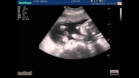 baby in womb 5 months.wmv - YouTube