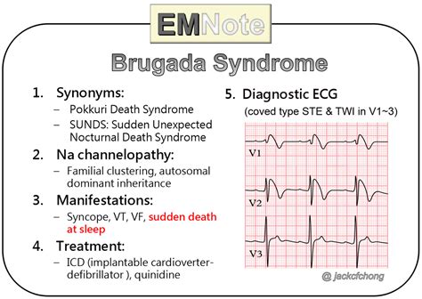 Brugada Syndrome Ekg Findings - Captions Hunter