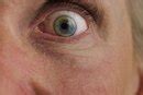 Do Dark Circles Under the Eyes Mean an Iron Deficiency? | LIVESTRONG.COM