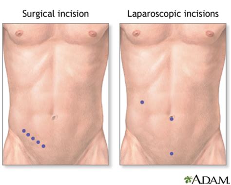 Laparoscopic Appendectomy Incision Sites