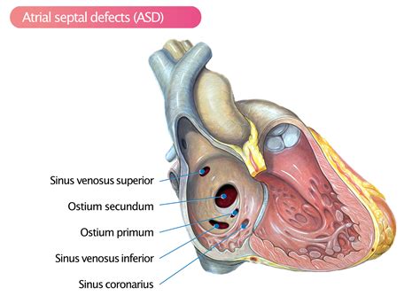 Congenital heart disease & GUCH (Grown Up Congenital Heart disease ...