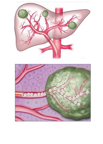 Liver Cancer Treatment: What is Chemoembolization? - Sahil Popli