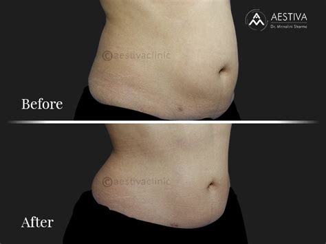 Liposuction Surgery in Delhi | Best liposuction surgeon in Delhi