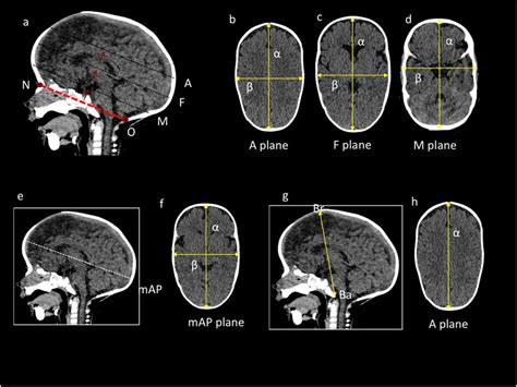 Skull shape severity quantification using traditional cephalic index... | Download Scientific ...