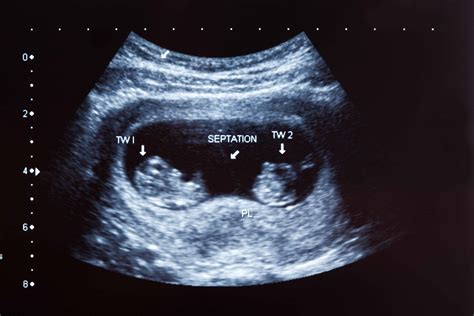 What Every Pregnant Woman Should Know About Screening Ultrasounds