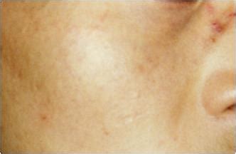 Q Switch Laser - Pigmentation & Birthmark Treatments