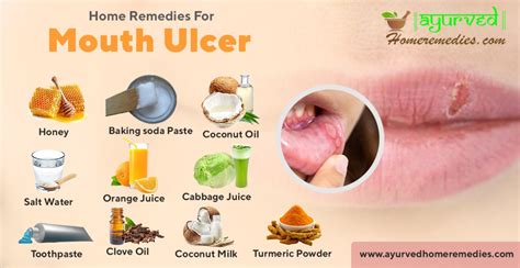 Who Else Wants Info About How To Reduce Mouth Ulcers - Effectsteak33