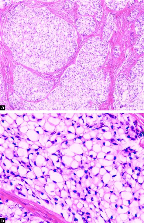 Photomicrograph of primary clear cell odontogenic carcinoma lesion... | Download Scientific Diagram