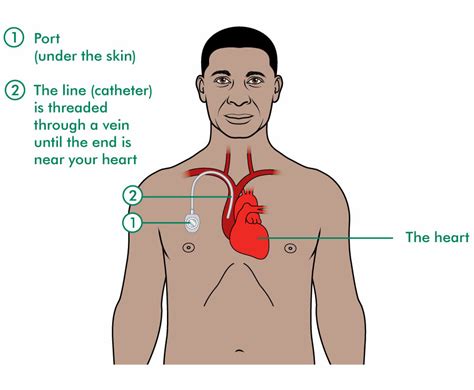 Chemotherapy Port