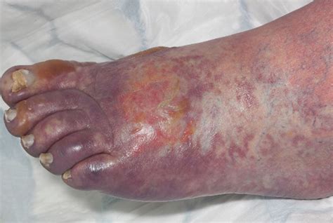 Diabetic sores on legs pictures | Symptoms and pictures