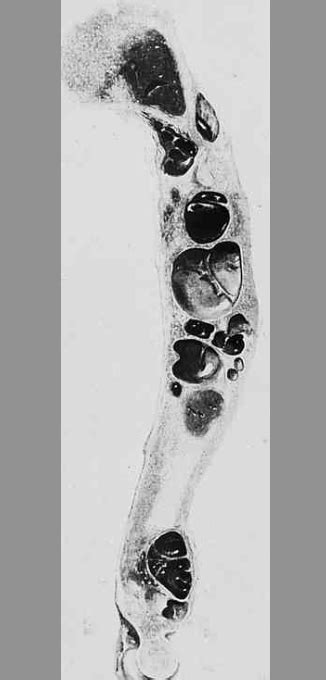 Osteitis Fibrosis Cystica — Medlibes: Online Medical Library