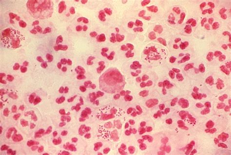 Free picture: gonorrhoeae, gonococci, patient, diagnosed, acute, gonococcal urethritis