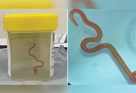 Unprecedented Discovery: Parasitic Roundworm Found in Woman's Brain